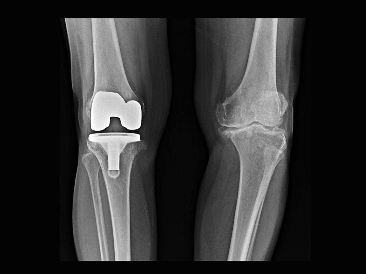 Exactech Knee Replacement Lawsuit Douglas and London